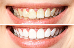 whitening