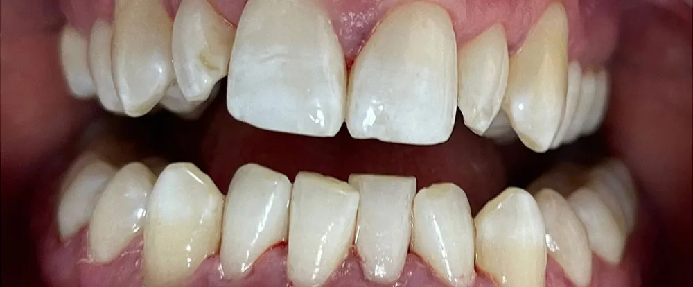 composite-bonding-a10