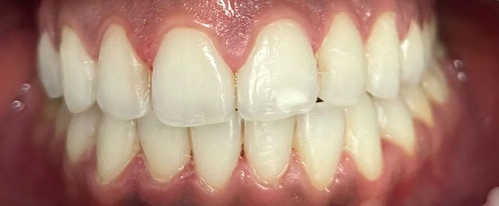 composite-bonding-a11