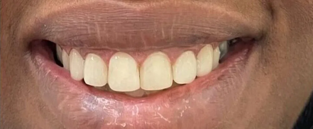 composite-bonding-a12