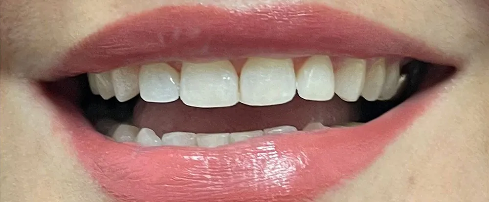 composite-bonding-a13