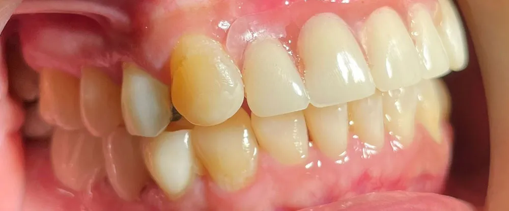 composite-bonding-a14