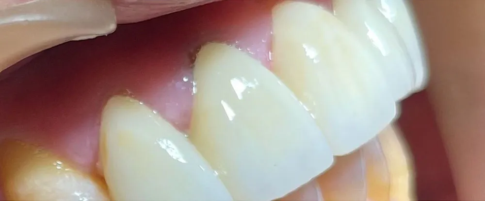 composite-bonding-a15