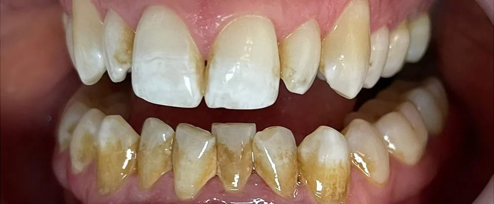 composite-bonding-b10