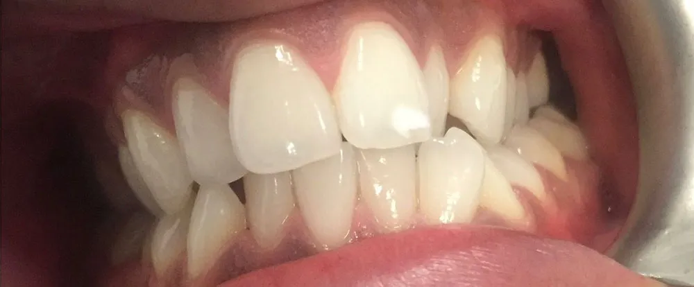 composite-bonding-b11