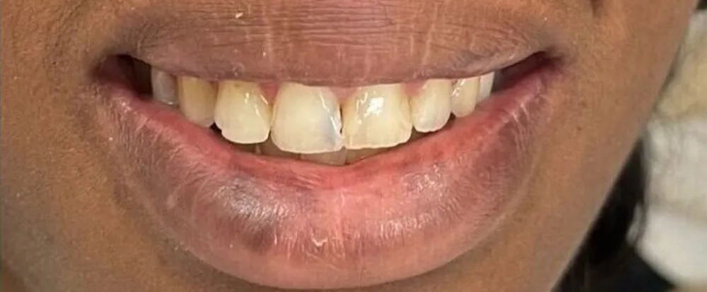 composite-bonding-b12