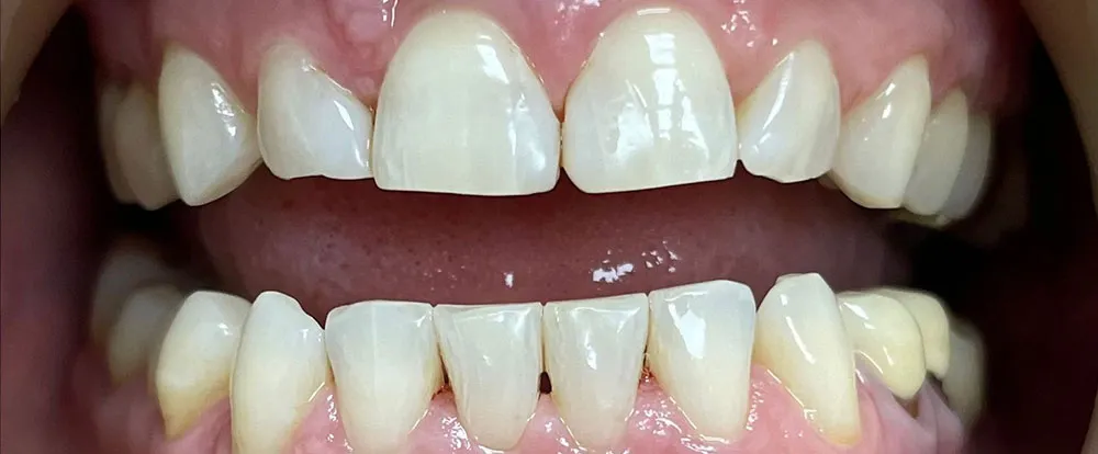 composite-bonding-b13