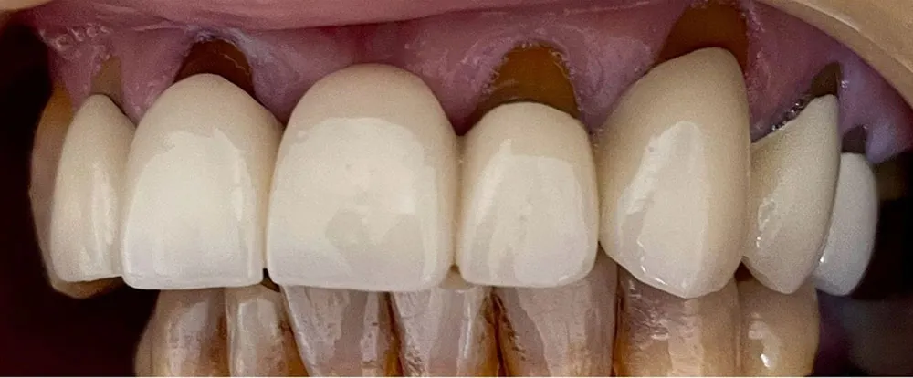 composite-bonding-b15