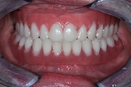 implants-a2 implants-a2