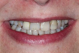 implants-b1 implants-b1