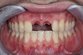 implants-b2 implants-b2