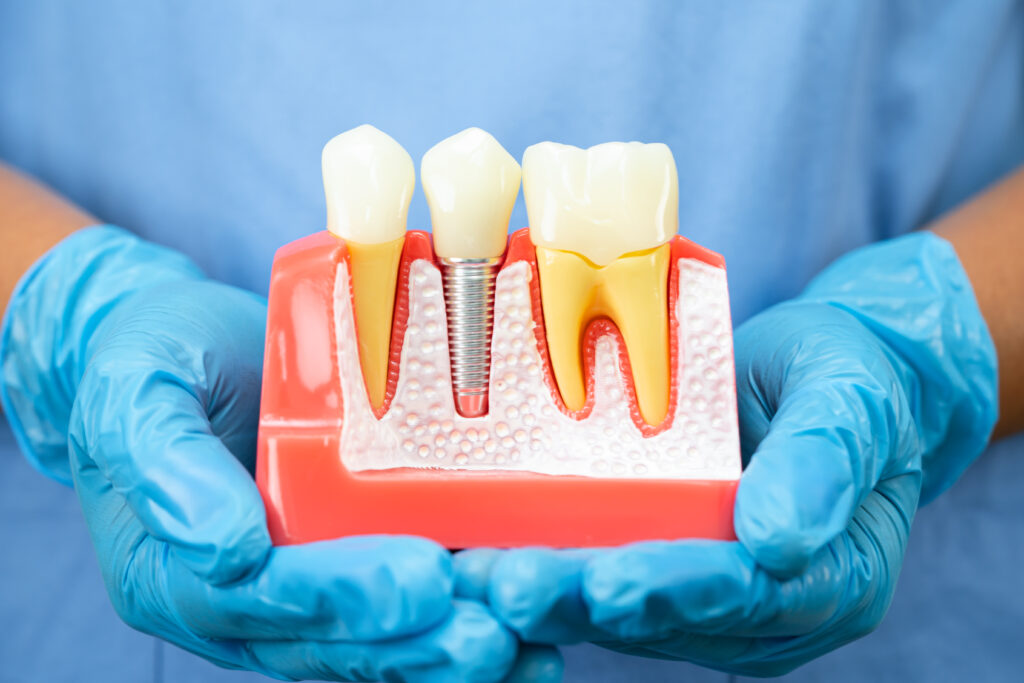 Dental Implants Recovery Time, Healing Stages and Aftercare